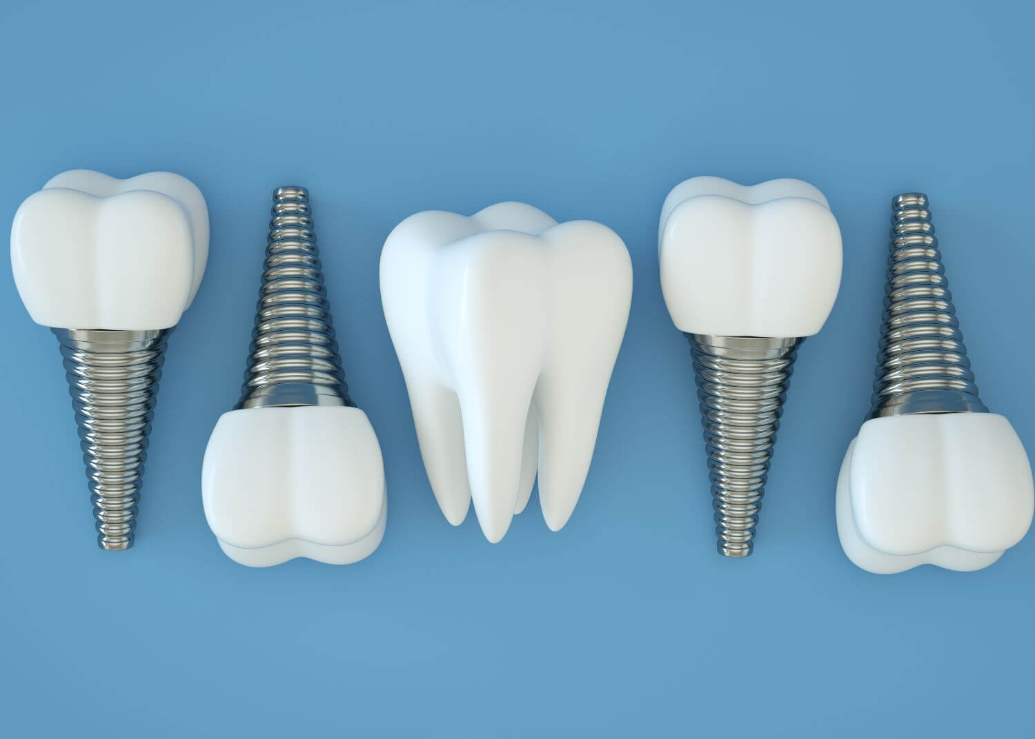 Single dental implants and natural teeth on a blue background