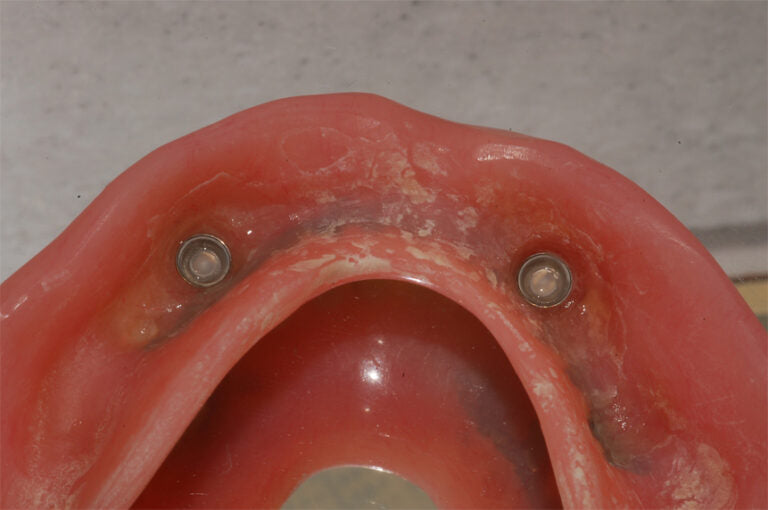Dental implant model with two screws on a gray background