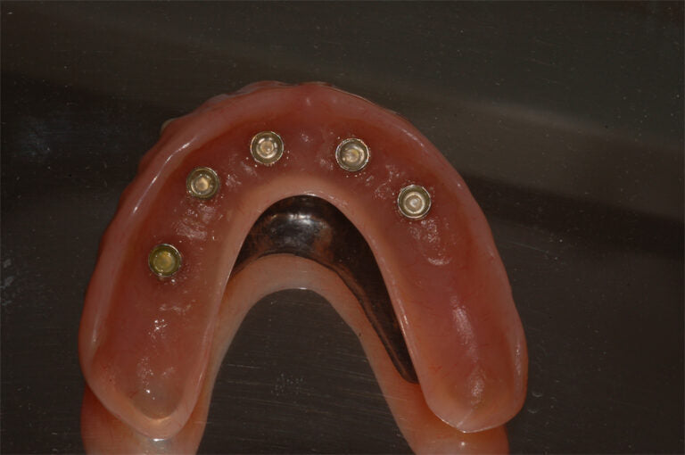 Dental implants in a model