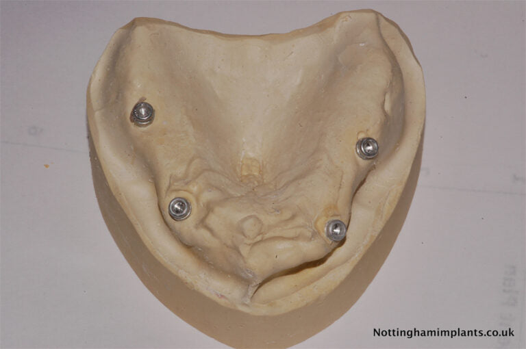 Dental implant model on a plain background