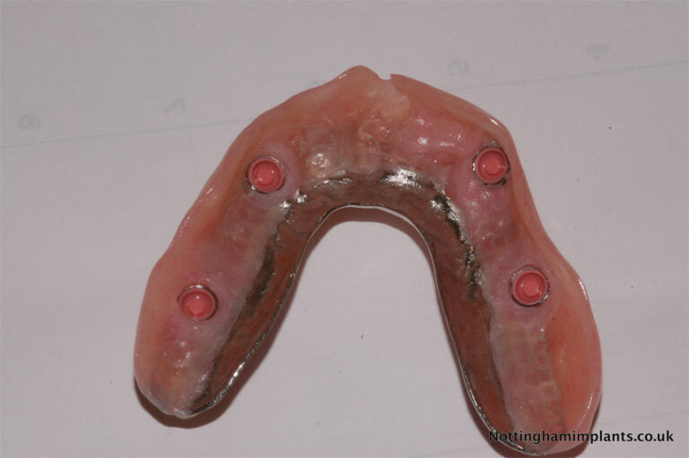 Dental implant model with red screws on a white background