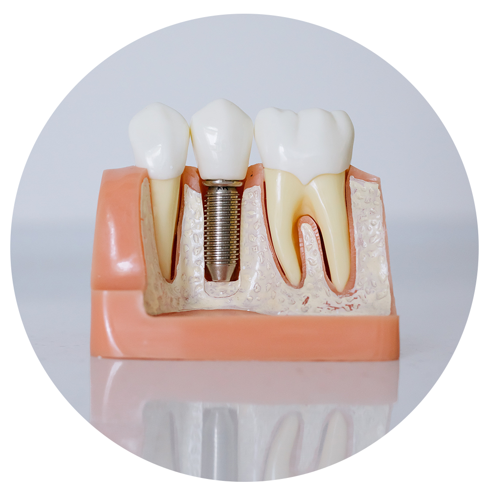 Model of a dental implant with teeth on a white background