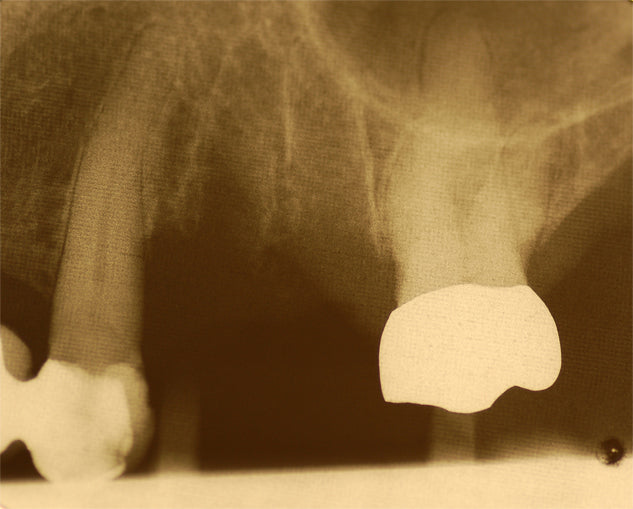 X-ray of a dental implant in place