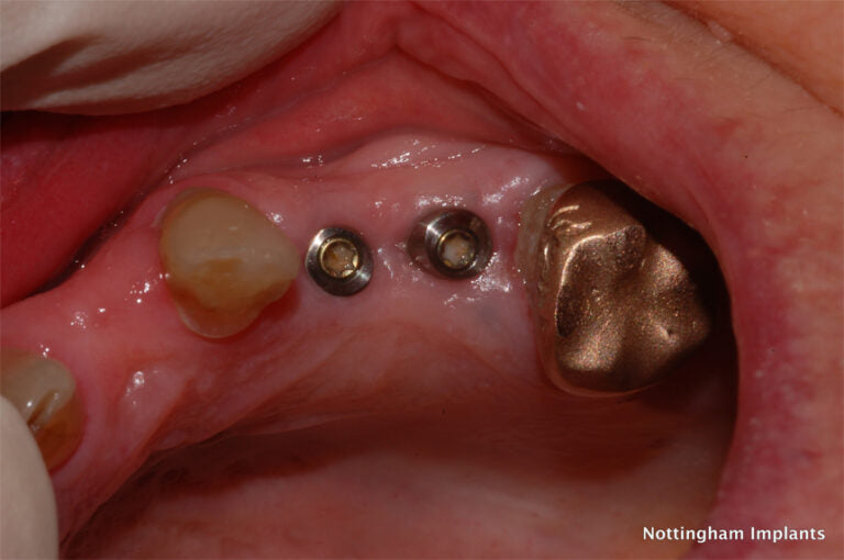 Close-up of dental implants and crowns in a mouth