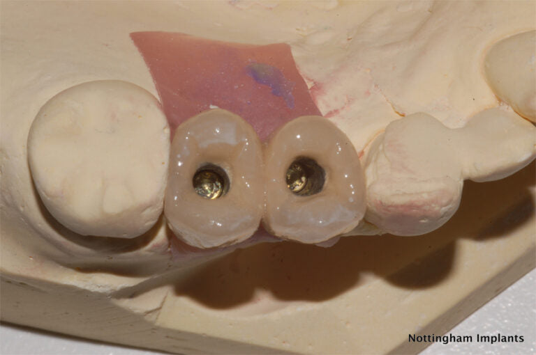 Dental model with dental implants on a neutral background