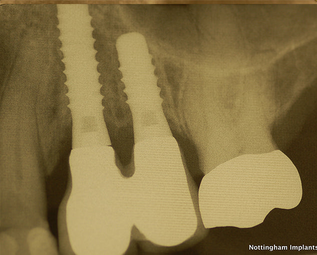 x-ray at Nottingham Implants