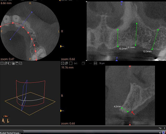 Medical imaging software interface with various views and measurements on a black background