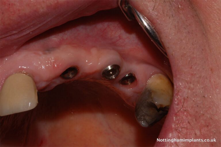 Close-up of dental implants in a mouth.