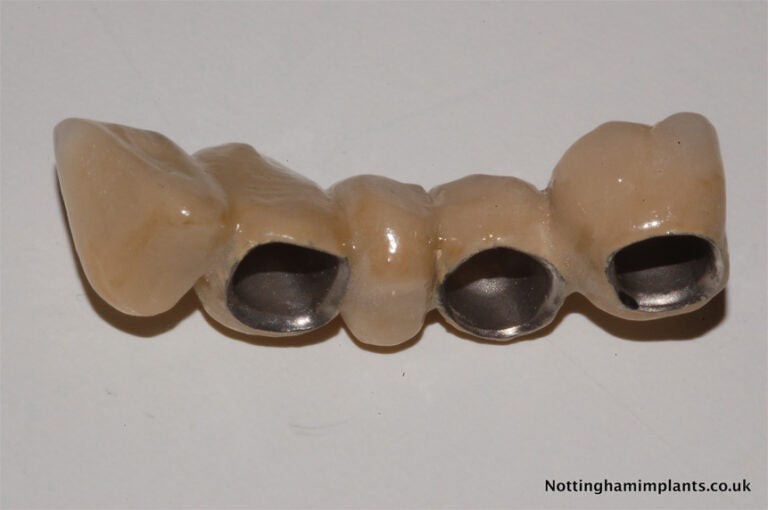 Dental implant component on a white background