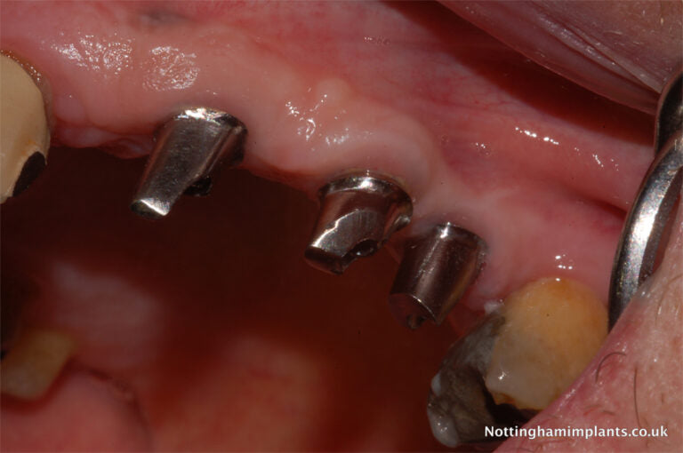 Dental implants and natural teeth close-up, showing metal fixtures and gum tissue.