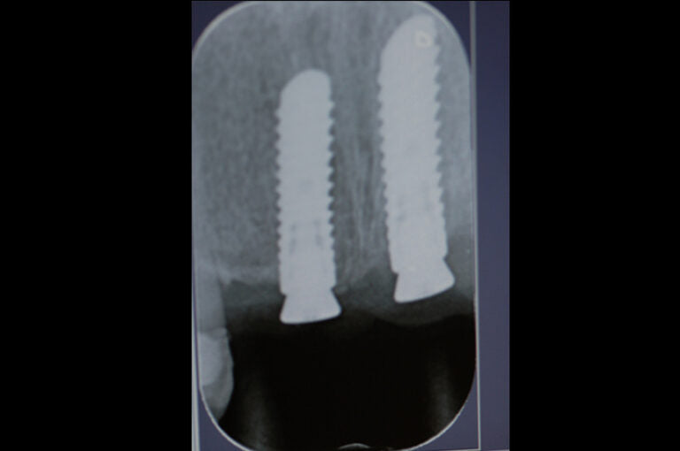 X-ray of dental implants in a patient's mouth