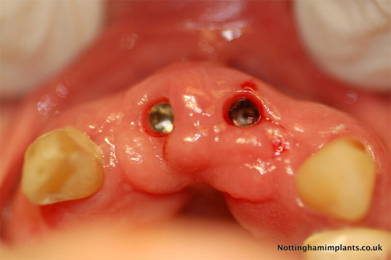 Dental implant model with screws 