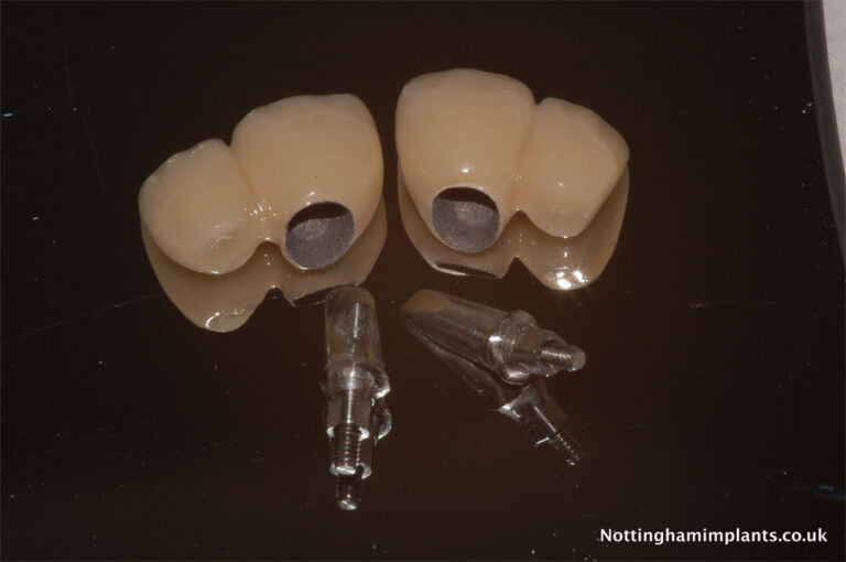 Dental implants and components on a dark background 