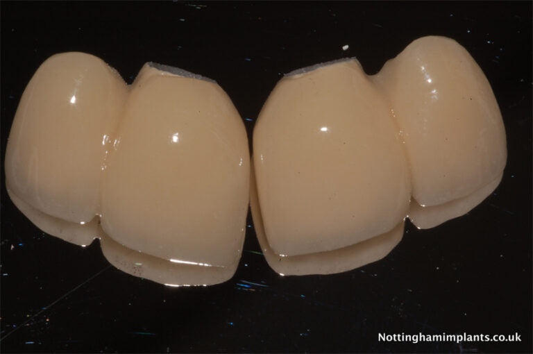Dental implant components on a black background 