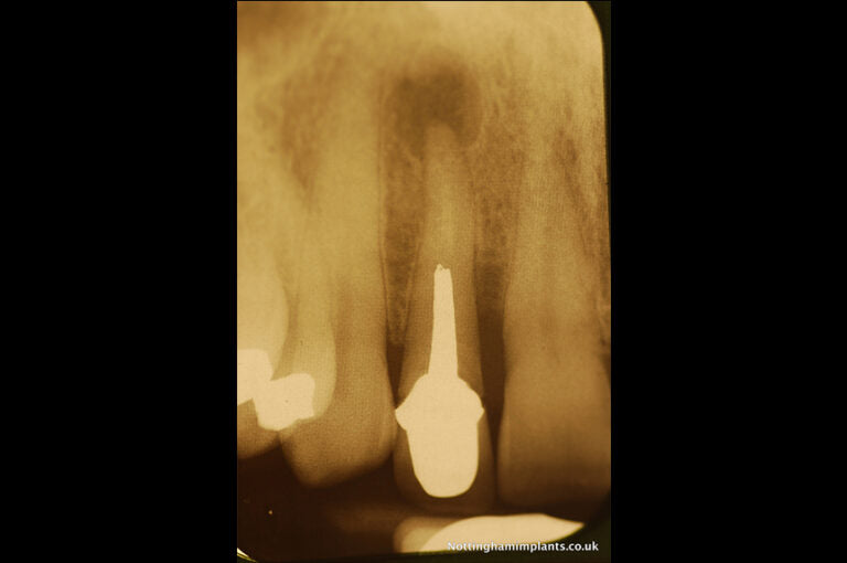 X-ray of a dental implant in place