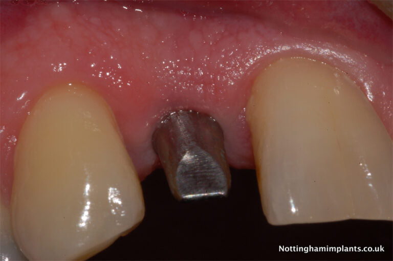 Dental implant in place between two natural teeth with visible gum line.