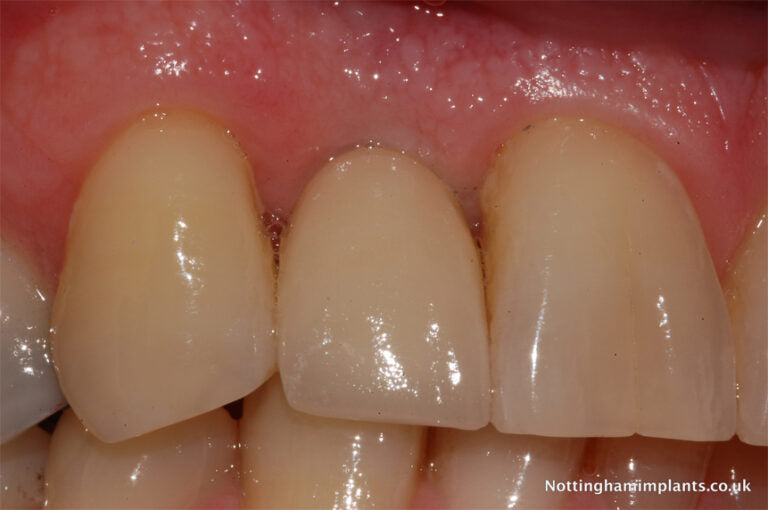 Close-up of dental implants and natural teeth