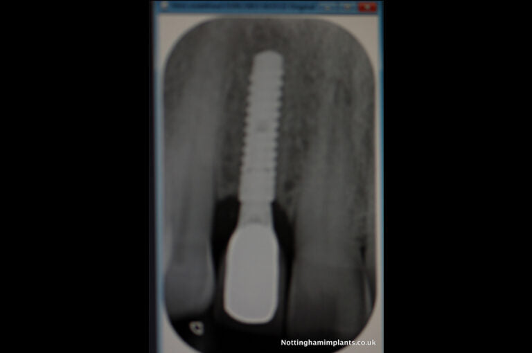 X-ray image of a dental implant 