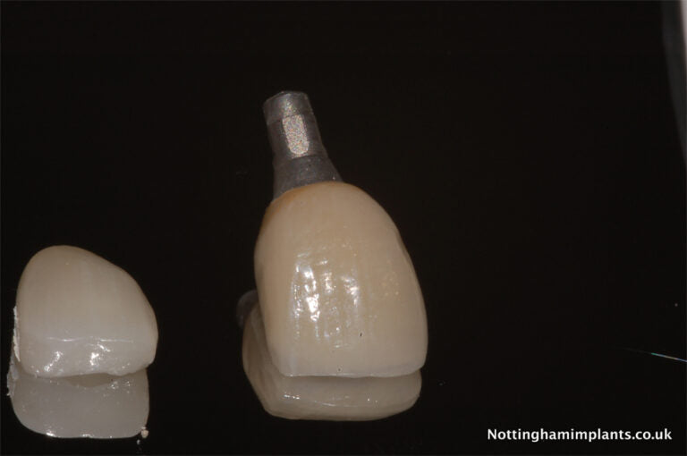 Two dental implants on a black background 