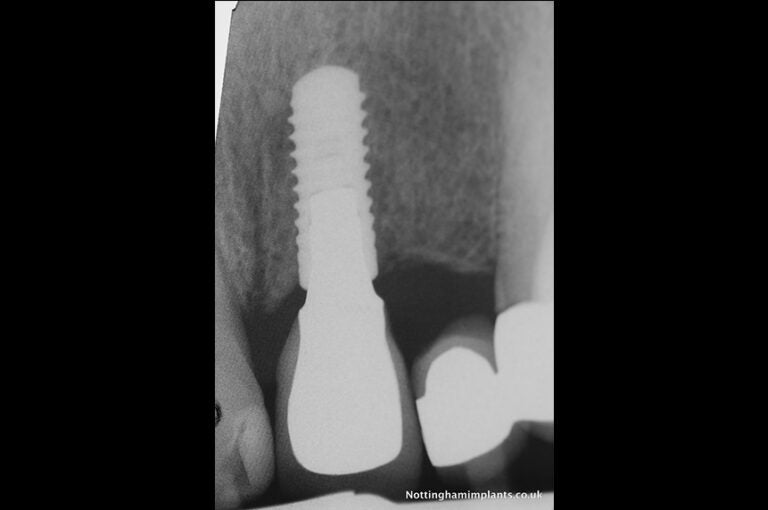 X-ray of a dental implant in place in the gum